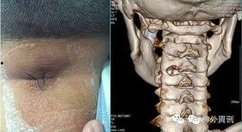 颈椎微创视频,颈椎微创手术操作步骤解析与技巧揭秘